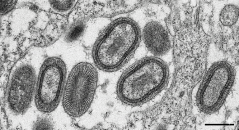 Mpox no Brasil: há casos confirmados em 2026? O que dizem os dados oficiais do Ministério da Saúde